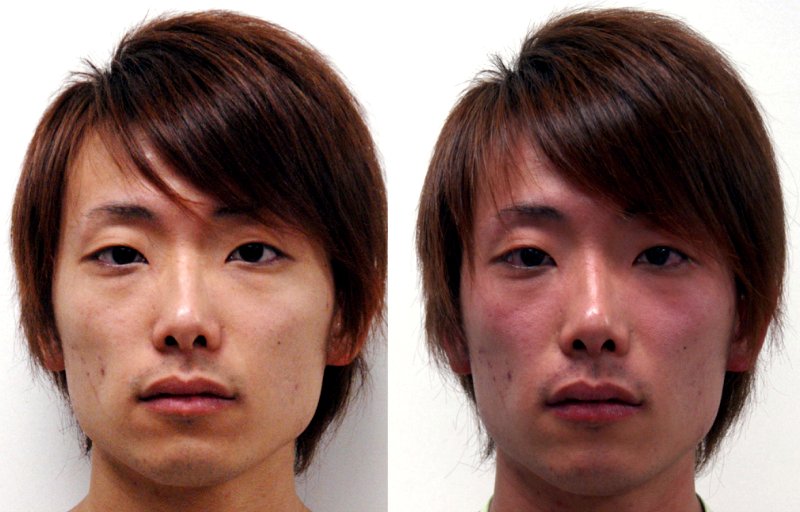 How to Cure the Infamous ‘Asian Glow’