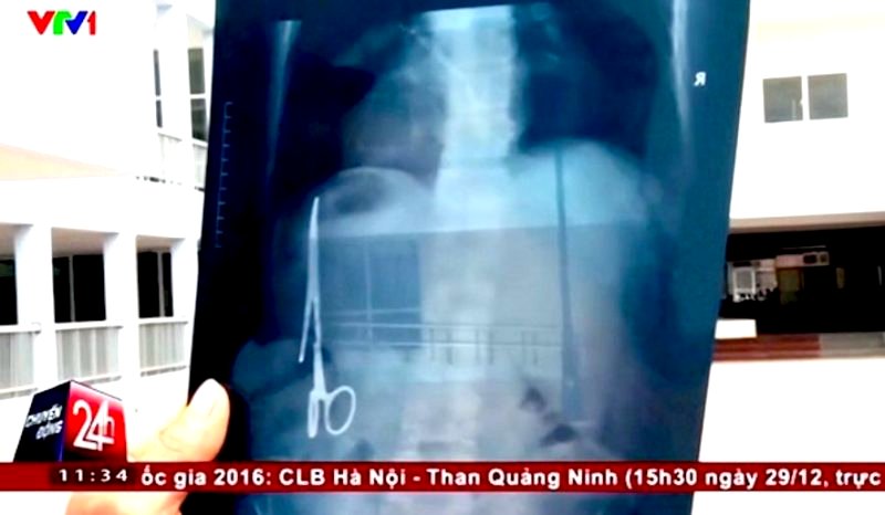 Surgeons From Vietnam Remove Scissors Stuck in Man’s Stomach for 18 Years