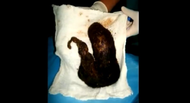 Indian Teen Gets Huge Furball Removed From Stomach Because She Can’t Stop Eating Her Hair