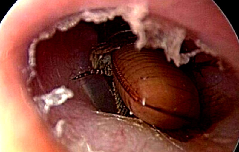 Elderly Chinese Man Takes Desperate Measures to Get Cockroach Out of His Ear