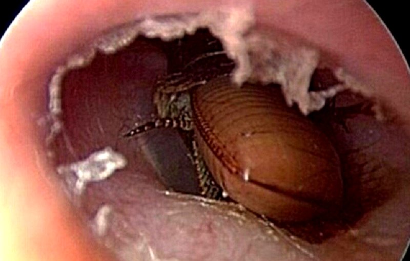 Elderly Chinese Man Takes Desperate Measures to Get Cockroach Out of His Ear