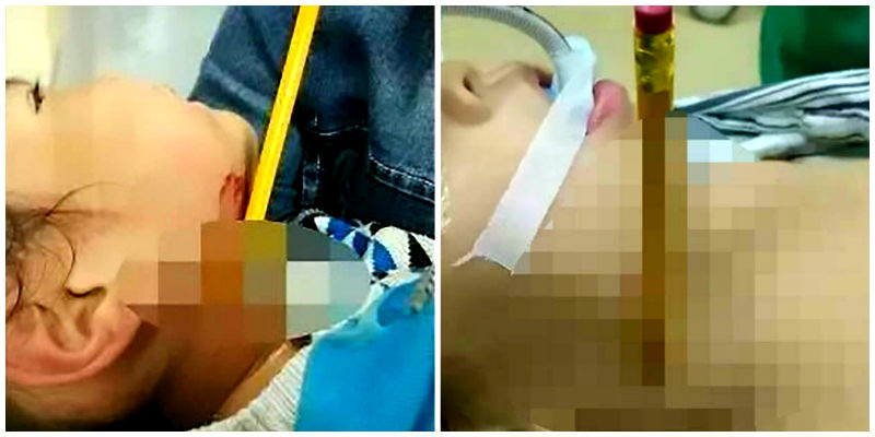 Chinese Toddler Survives After Stabbing Herself in the Throat With a Pencil