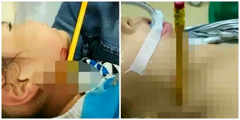 Chinese Toddler Survives After Stabbing Herself in the Throat With a Pencil