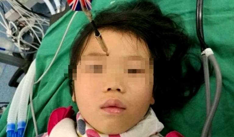 7-Year-Old Chinese Boy Accidentally Throws 4-Inch Dart at His Sister’s Forehead