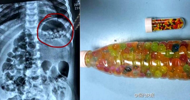 Chinese Parents Accidentally Feed 3-Year-Old Daughter Plastic Balls They Thought Were Candy