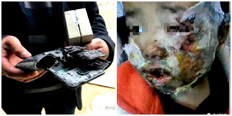 Samsung Phone Explodes on 5-Year-Old Girl’s Face in China