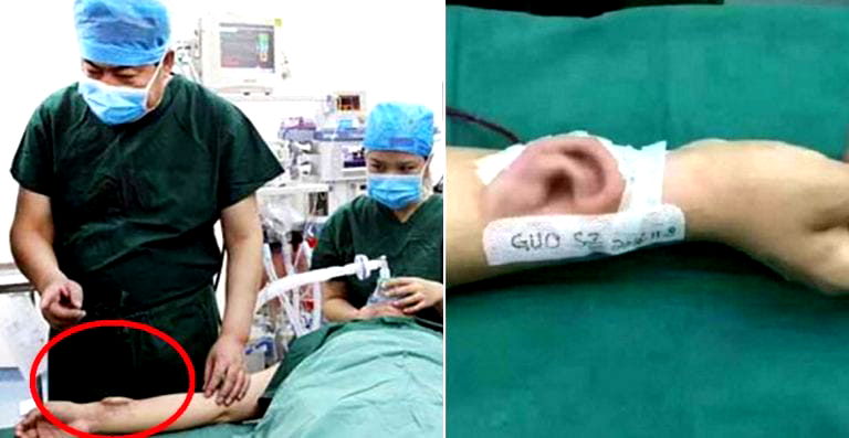 Chinese Doctors Successfully Give Patient New Ear After Growing One on His Arm