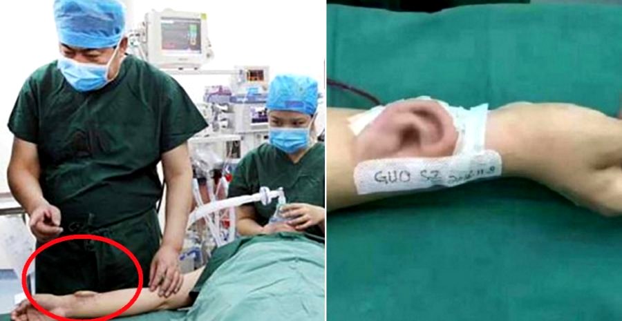Chinese Doctors Successfully Give Patient New Ear After Growing One on His Arm