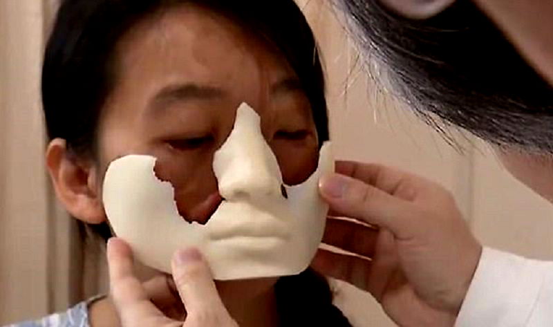 Chinese Doctors to Fix Woman’s Disfigured Face By Growing a New One on Her Chest