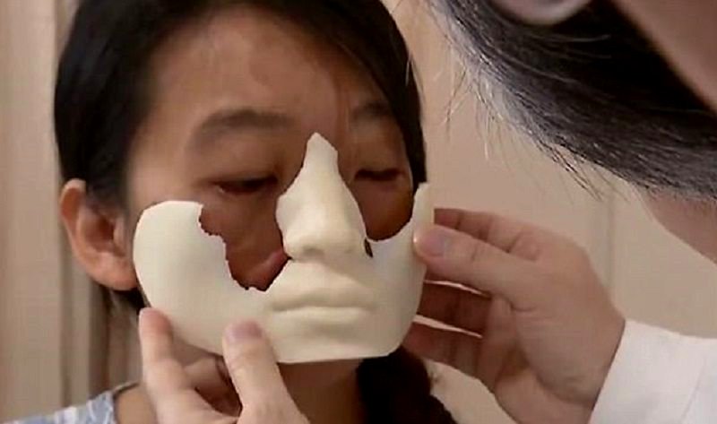 Chinese Doctors to Fix Woman’s Disfigured Face By Growing a New One on Her Chest