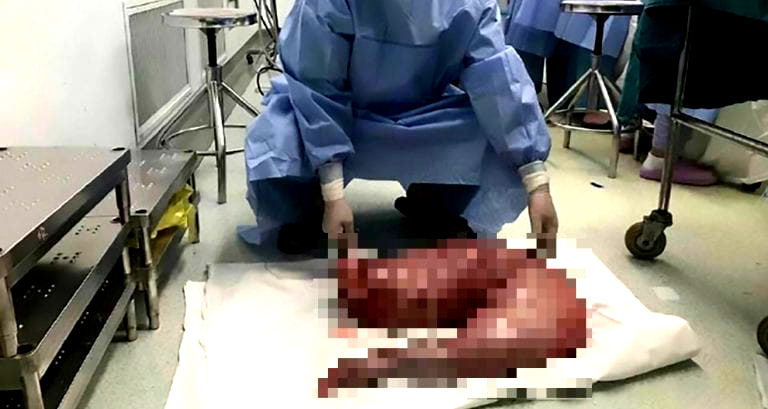 Chinese Surgeons Remove 30 Inches of Man’s Intestines to Relieve Painful Constipation