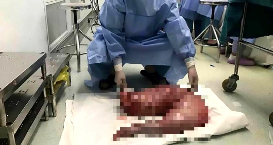 Chinese Surgeons Remove 30 Inches of Man’s Intestines to Relieve Painful Constipation