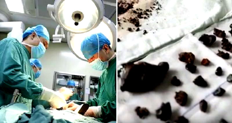 Surgeons Remove Over 200 Stones From Chinese Woman’s Body Because She ‘Skips Breakfast’