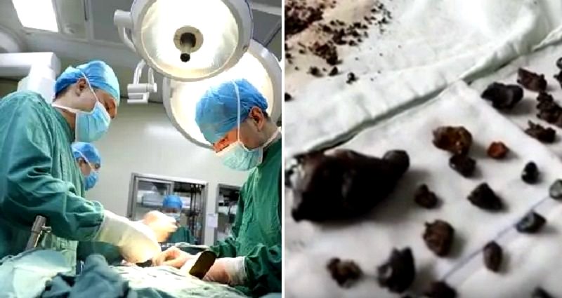 Surgeons Remove Over 200 Stones From Chinese Woman’s Body Because She ‘Skips Breakfast’