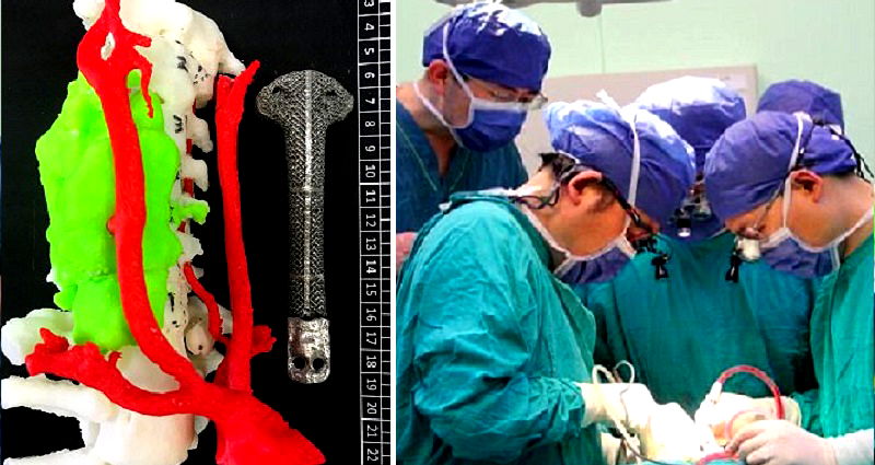 Chinese Doctors Replace Cancer Patient’s Spine With 3D Printed Vertebrae