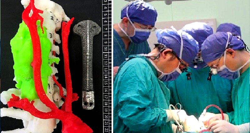Chinese Doctors Replace Cancer Patient’s Spine With 3D Printed Vertebrae