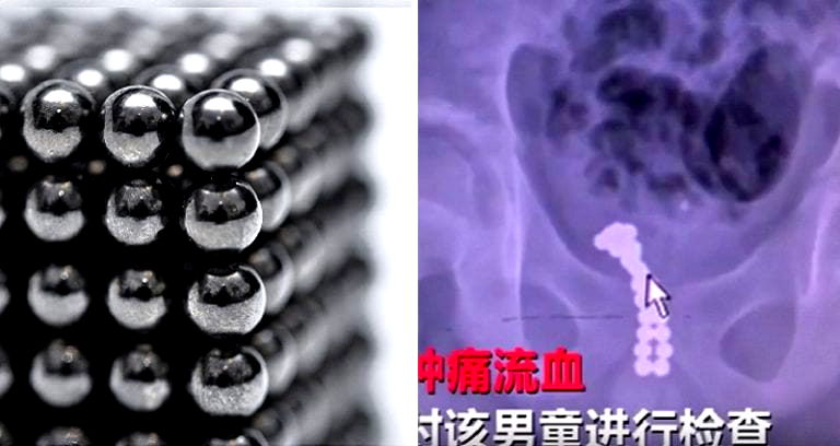 Surgeons In China Save Boy Who Stuck 26 Magnets Up His Penis