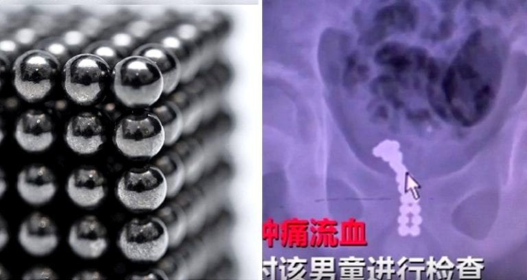 Surgeons In China Save Boy Who Stuck 26 Magnets Up His Penis