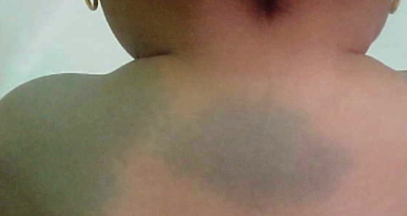 Why Some Asians Have a Vanishing Blue Birthmark Called A ‘Mongolian Spot’