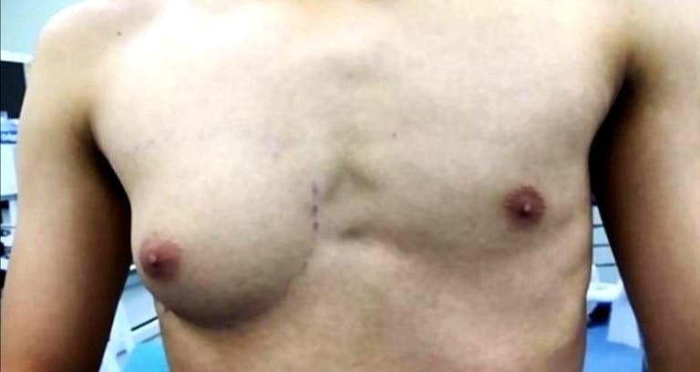 Chinese Teen Undergoes Surgery to Have Boob-Like Lump Removed