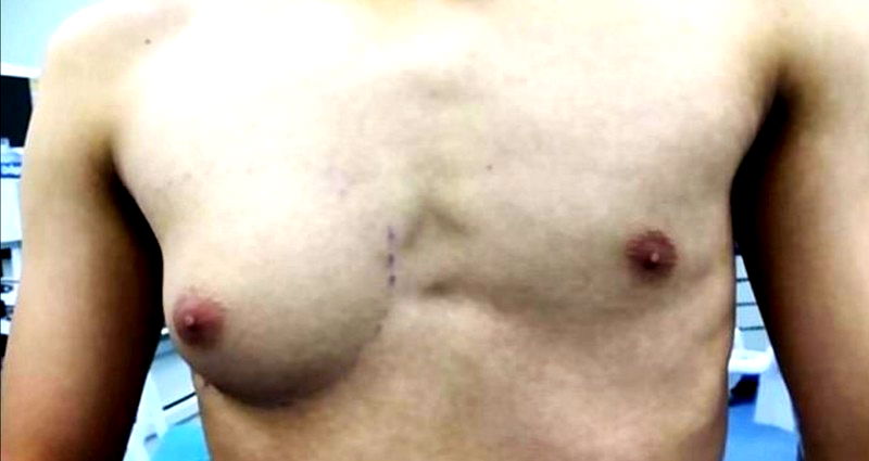 Chinese Teen Undergoes Surgery to Have Boob-Like Lump Removed