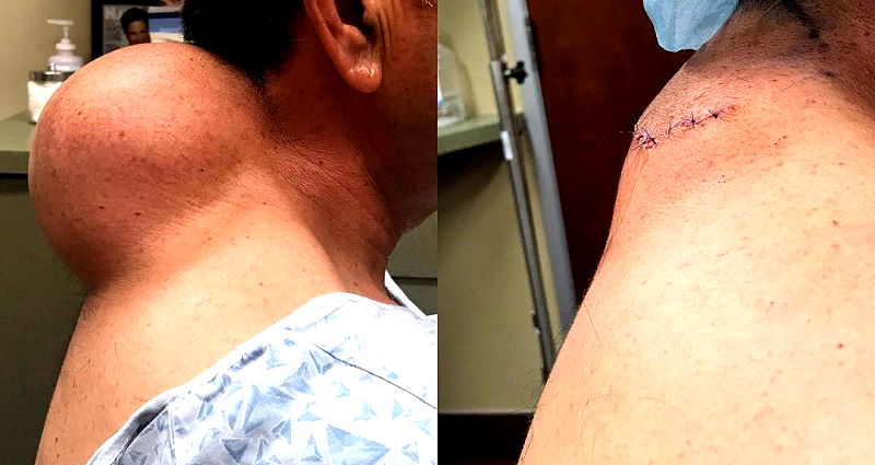 Dr. Pimple Popper Raises $5,000 for Hurricane Harvey Relief With the Most Epic Pimple Pop