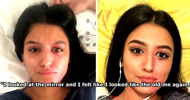 Aspiring Model Reveals How She ‘Recovered’ Her Looks After Suffering Horrific Acid Attack