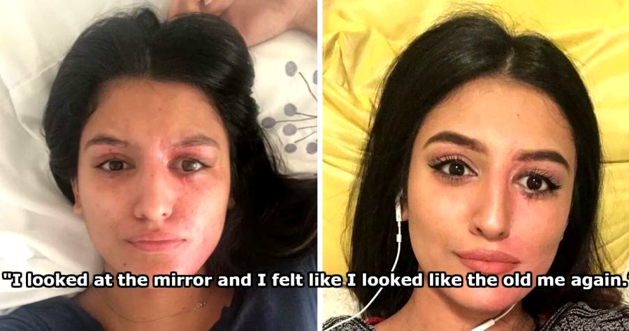 Aspiring Model Reveals How She ‘Recovered’ Her Looks After Suffering Horrific Acid Attack