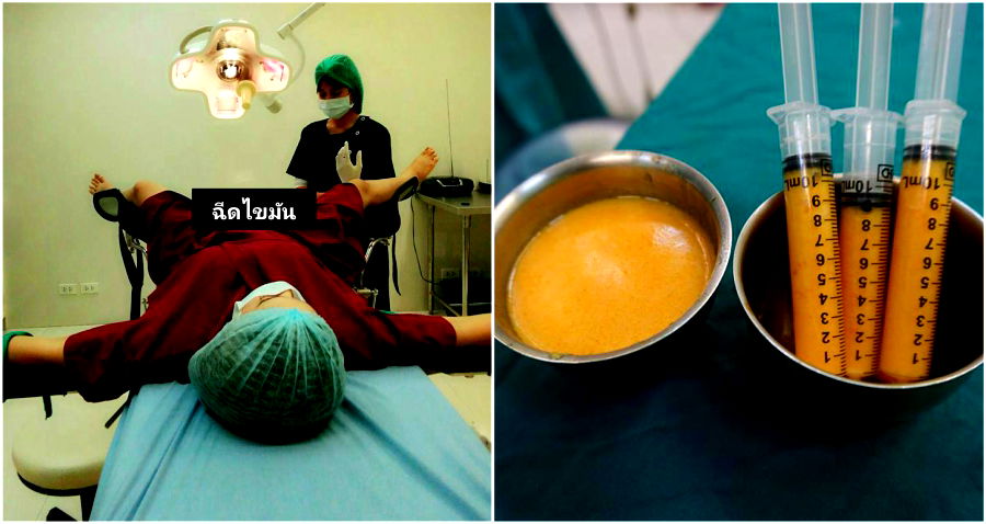 Women in Thailand Are Now Getting $1,500 Surgery for ‘3D Vaginas’