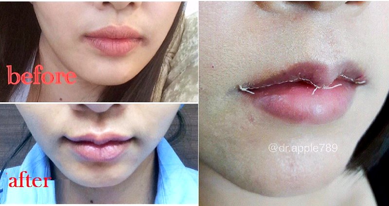 Asian Women Are Now Getting Surgery To Have Thinner ‘Caucasian’ Lips