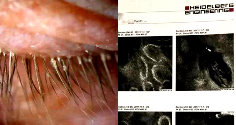 Chinese Woman’s ‘Itchy Eyes’ Turns Out to Be 100 Parasites Living in Her Eyelashes