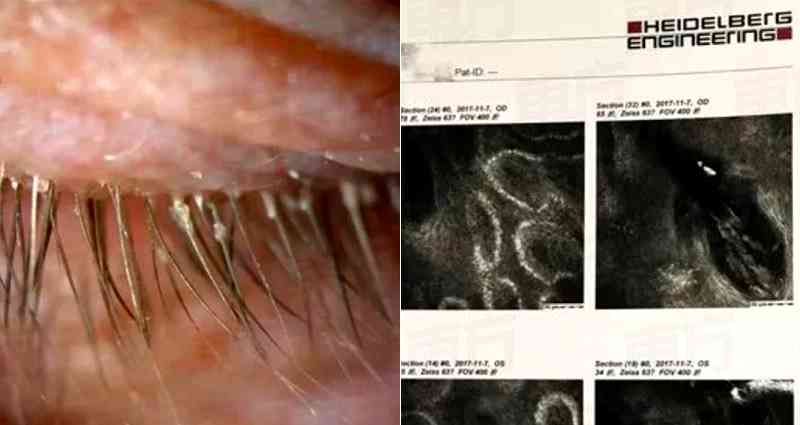 Chinese Woman’s ‘Itchy Eyes’ Turns Out to Be 100 Parasites Living in Her Eyelashes