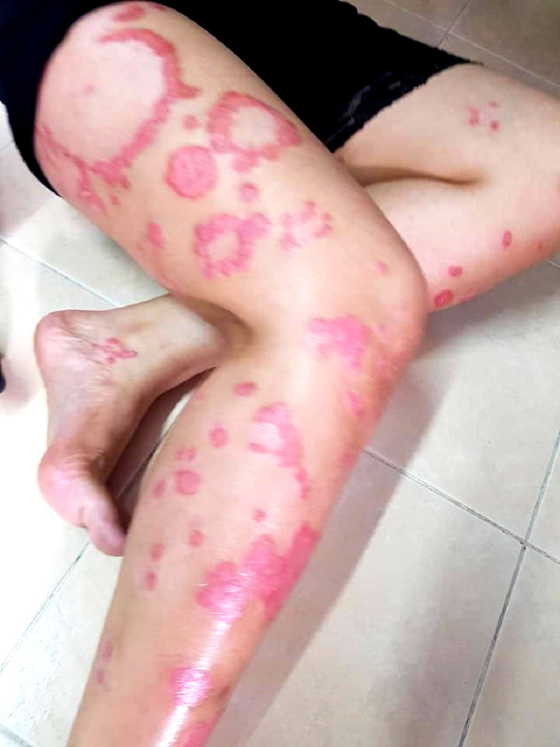 thai woman suspended from job after customers thought her psoriasis was aids