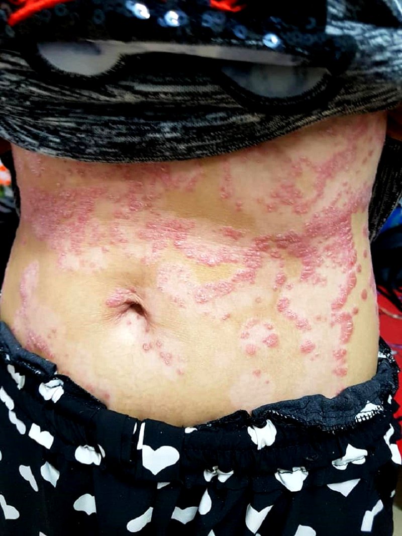 thai psoriasis patient lost her job and husband