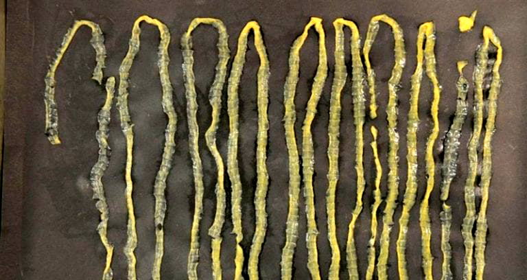 Doctors Extract 9-Foot Tapeworm From Singaporean Man’s Rectum