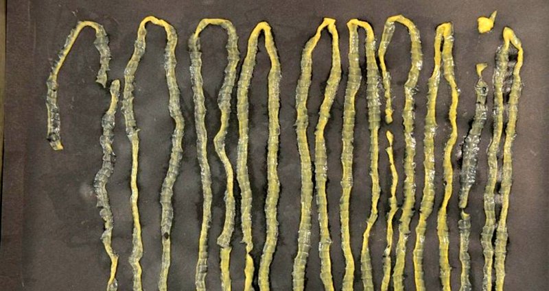 Doctors Extract 9-Foot Tapeworm From Singaporean Man’s Rectum