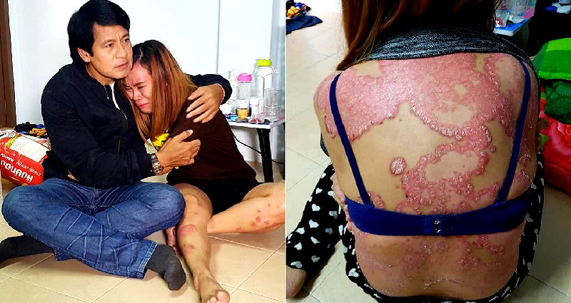 Thai Woman With Psoriasis Loses Her Husband and Job Over Fears She Has AIDS