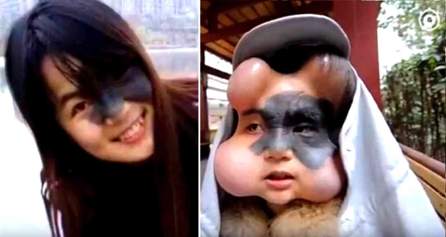 Brave Chinese Woman Gets Balloons Implanted in Face to Help Remove Dangerous Birthmark