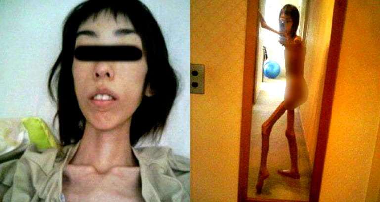 Japanese Abuse Survivor Shares Heartbreaking Photos of Life at 37 Pounds