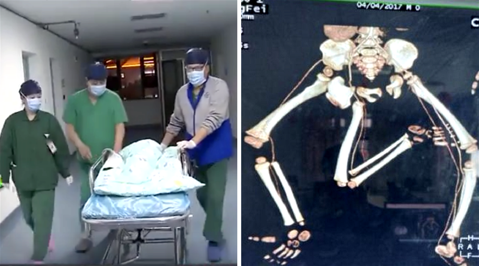 Baby Born With Three Legs Undergoes Complex 10-Hour Surgery in China
