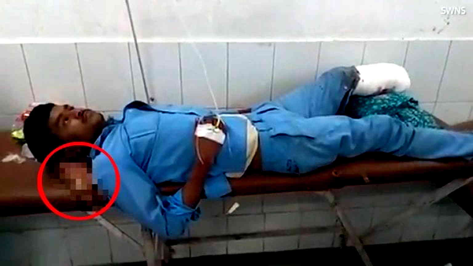 Car Accident Victim Uses Own Amputated Foot As Pillow When Hospital in India Doesn’t Treat Him