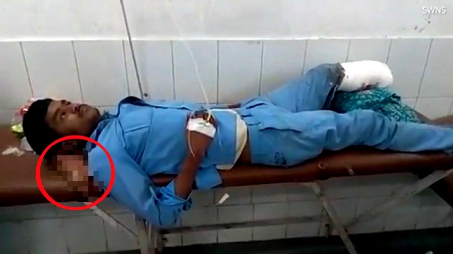 Car Accident Victim Uses Own Amputated Foot As Pillow When Hospital in India Doesn’t Treat Him
