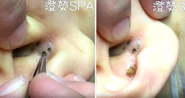 Blackhead Extraction Video from Chinese Spa is for Pimple Popping Diehards Only