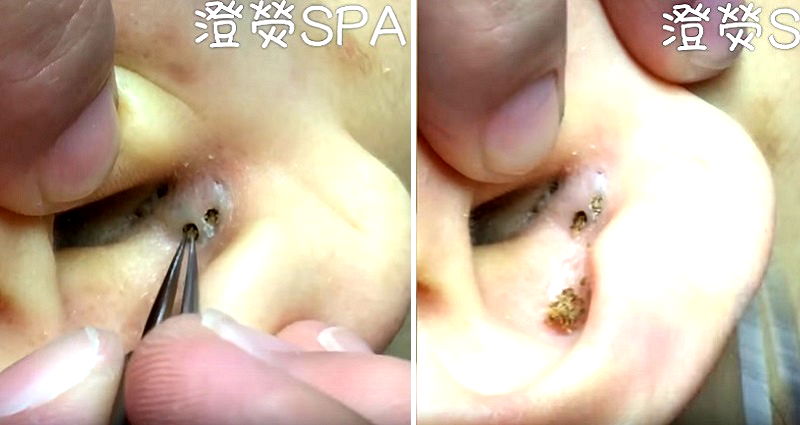 Blackhead Extraction Video from Chinese Spa is for Pimple Popping Diehards Only