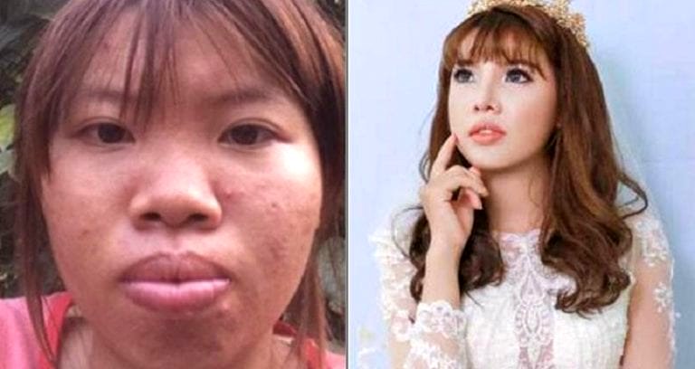 Bullied Vietnamese Girl Regains Self-Confidence With $14,000 of Plastic Surgery
