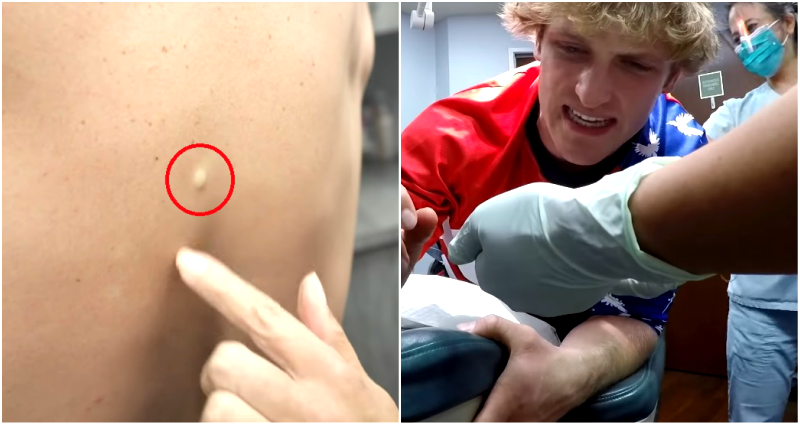 Dr. Pimple Popper Squeezes Cyst Out of Logan Paul, Netizens Disgusted
