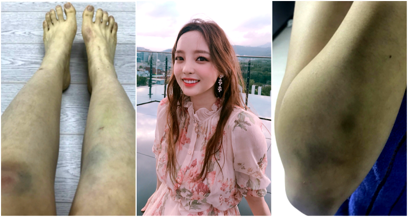 Former K-Pop Idol Posts Disturbing Photos After Boyfriend Allegedly Assaults Her