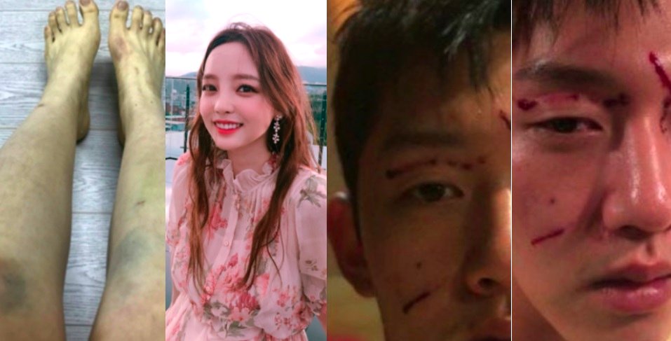 Ex-Boyfriend Who Allegedly B‌e‌at K-Pop Idol Girlfriend Shares Photos Of His Own Injuries
