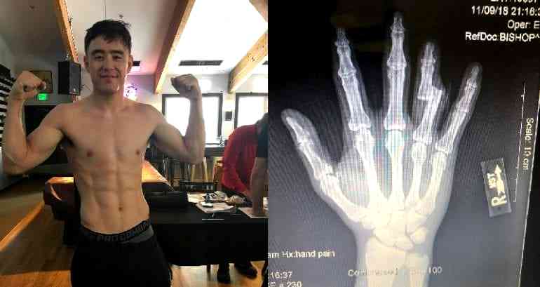 MMA Fighter Harvey Park Wins Fight With Bone Sticking Out of His Finger