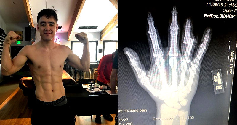 MMA Fighter Harvey Park Wins Fight With Bone Sticking Out of His Finger